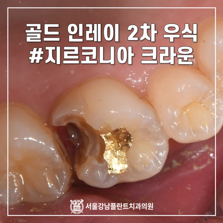  골드 인레이 2차 우식 - 지르코니아 크라운 재치료