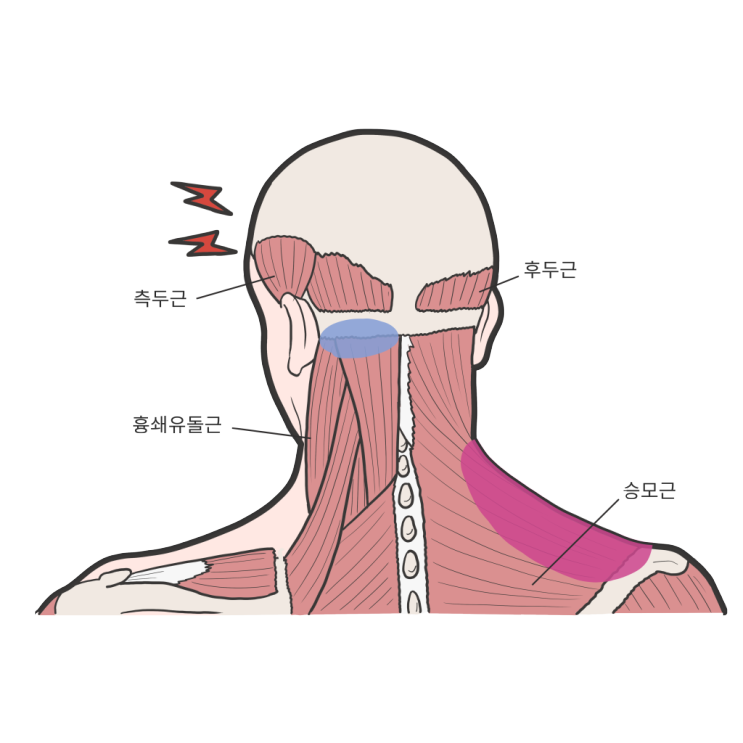 뒷머리 찌릿, 뒷머리 통증 - 경추성 두통, 근긴장성 두통