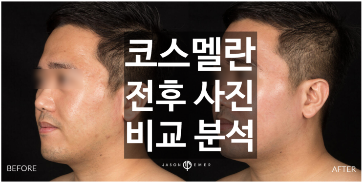  다양한 코스멜란 전후 사진 비교 분석 (거뭇거뭇) 첫 번째 - 할리우드 제이슨 에머 MD 피부과