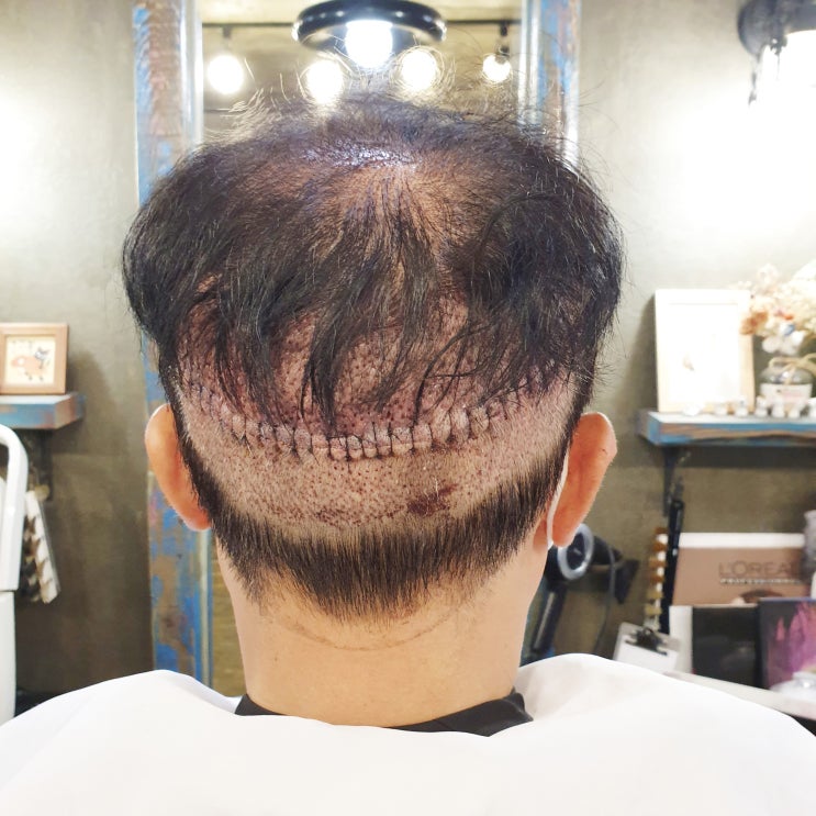  이마 넓은 남자 모발이식했다면?