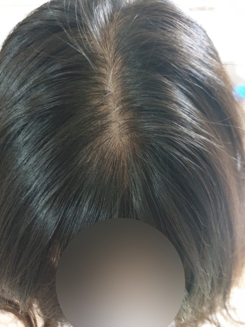 두피주사(탈모치료) 1년 3개월 후