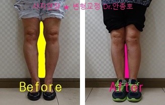  무릎의 오다리 변형교정