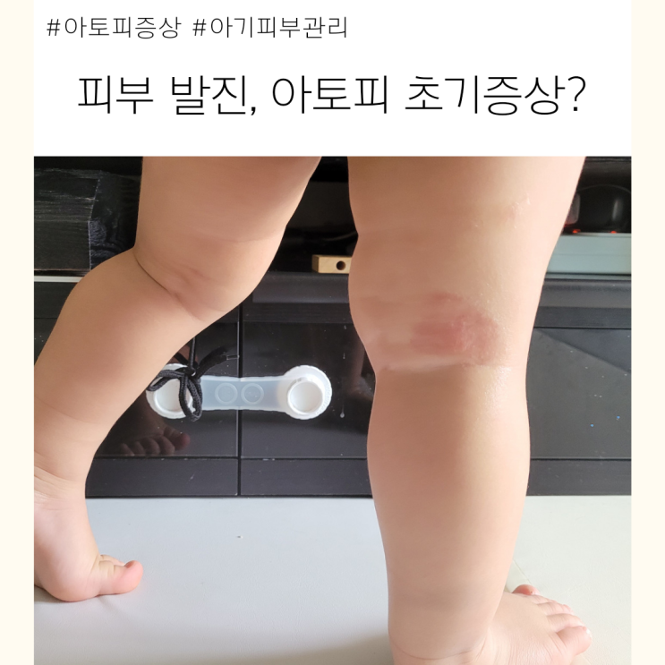  아기 피부염 아토피 초기 증상 관리 어떻게 해야할까?