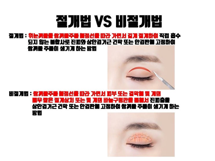  저라면 부분절개 쌍수할 바에 차라리 자연유착 쌍수합니다.