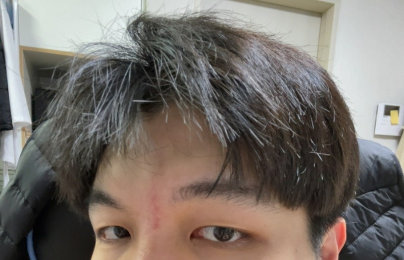어린이 흉터 수술, 도그이어 제거 수술 국소 마취 및 낮잠 수술 리뷰 10