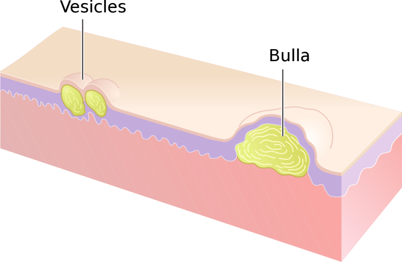 [PK 생활] 피부과. pruritus, macule, papule, vesicle, bulla, pustule, wheal ...
