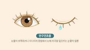 안구건조증에 도움되는 습관상식 가습기 인공눈물 영양제:루테인 오메가3 안구건조증효능