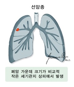 폐암의 종류
