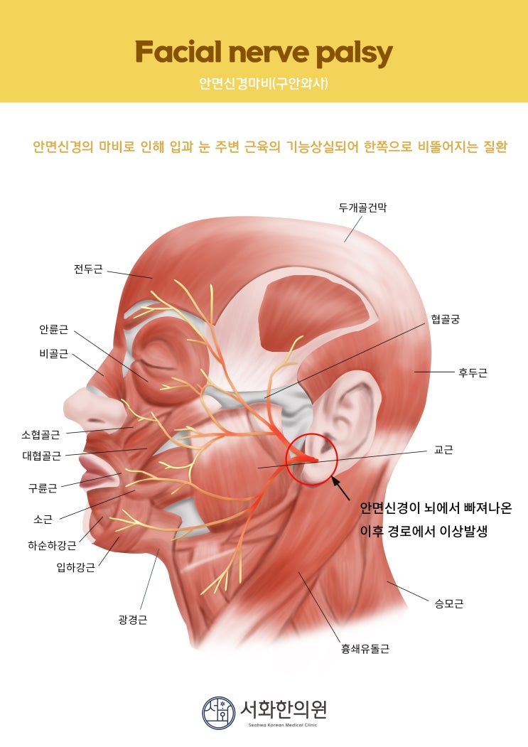  안면신경마비(Facial palsy) 벨마비(Bell’s palsy)