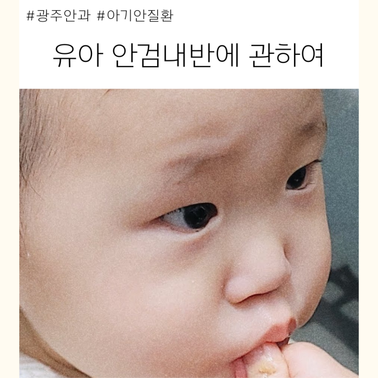  광주안과 궁금해요! 유아 안검내반 수술 필수인가요?