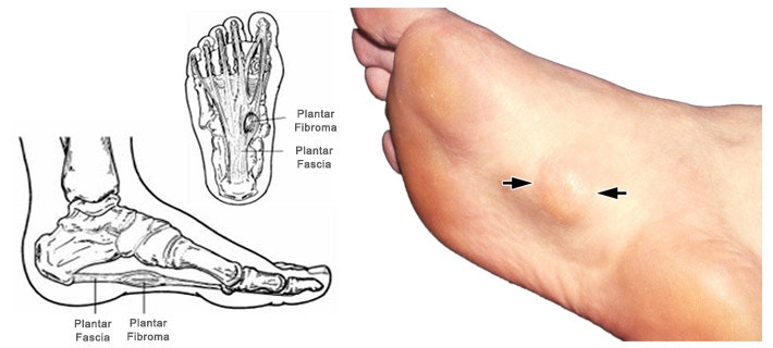 만석동 발바닥 섬유종증(Plantar fibromatosis) case:발바닥 멍울이 뭔가요?/피지낭종제거,물혹제거,....