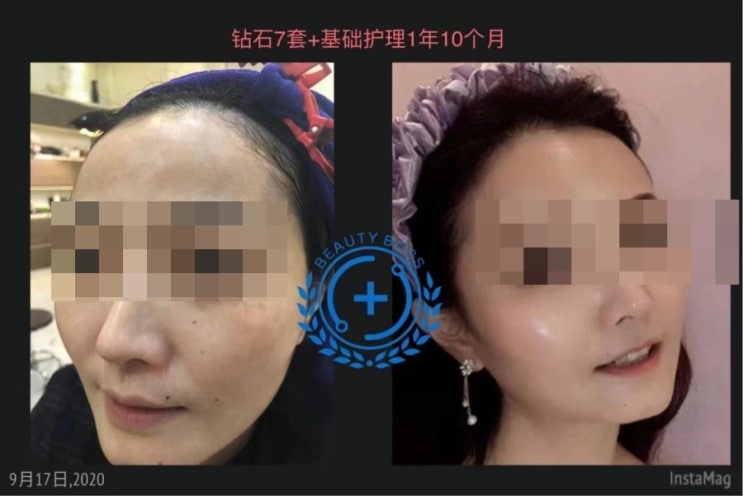  [르네셀] 르네셀 화장품 사용 전후 비교