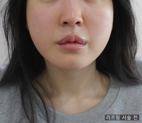  민트실리프팅 시술방법과 가격