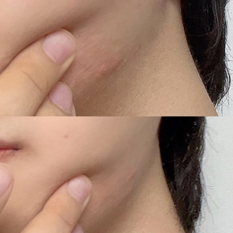  남자 턱 여드름 원인 해결한 방법