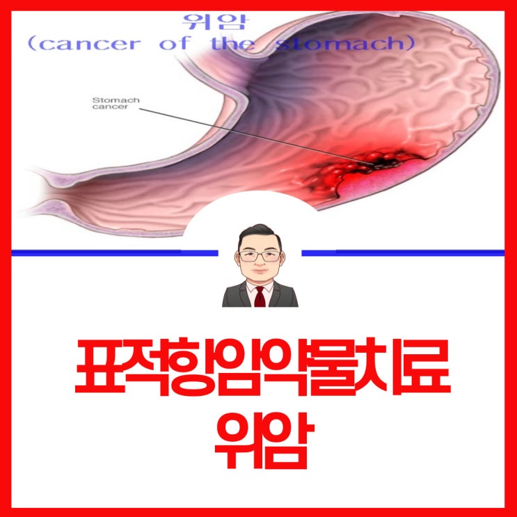 표적항암약물치료제 남녀 암발병율높은 위암