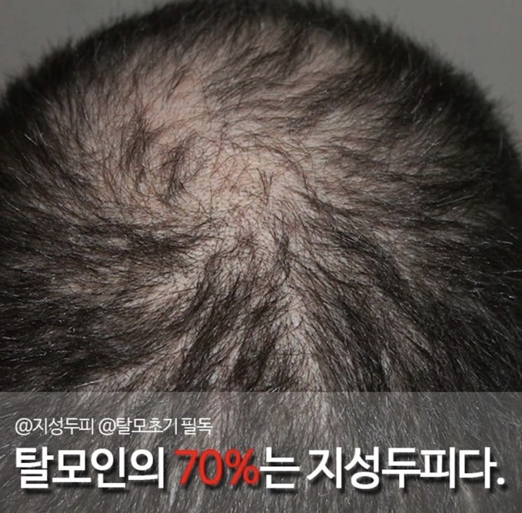  베버힐 탈모토닉 마지막 100세트 남았다요 cc 월요일 바로 출고분 open ️내가 탈모인줄 몰랐다구요???