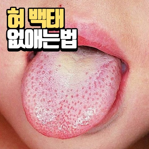 혀 백태(설태) 원인과 제거 효과만점 없애는법 : 네이버 블로그