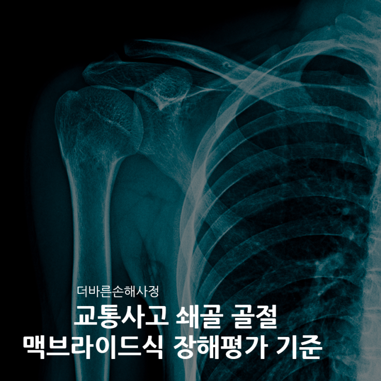  쇄골 골절 맥브라이드식 기준은?