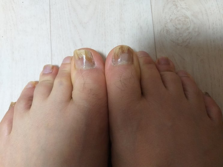  발톱 무좀 약 복용 80일 경과