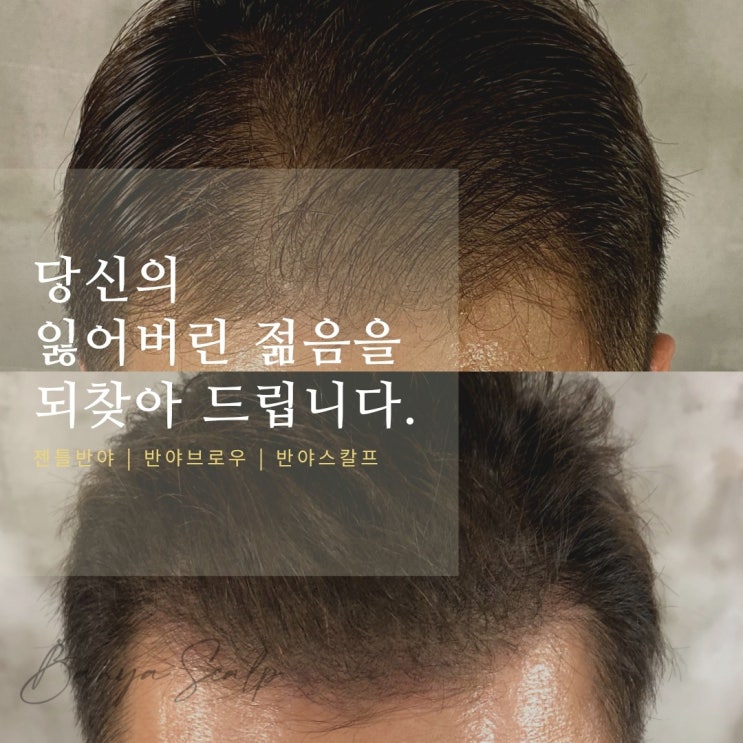  [반야스칼프-탈모이야기] 탈모고민!! 당신의 잃어버린 젊음을 되찾아드립니다.-