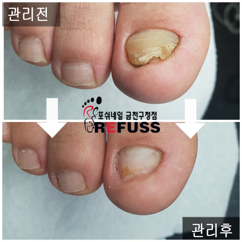 금천구 발톱무좀 고민 발관리 전문샵 미모네일닥터ITN