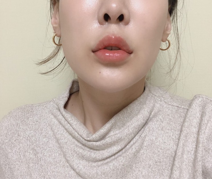  국산 채움 입꼬리 입술 필러 내돈내산 솔직 후기