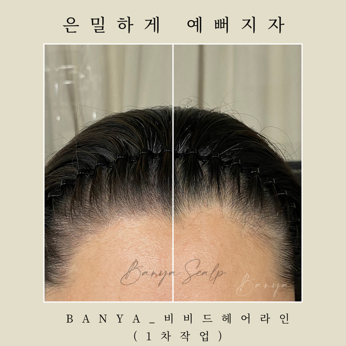  [반야스칼프-탈모이야기] 은밀하게 예뻐지자!! 넓은이마 고민해결!! 헤어라인반영구후기