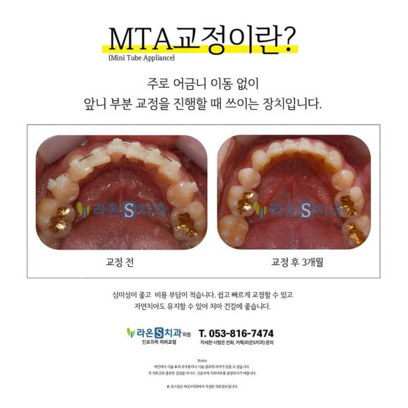 대구 치열교정 전후 후기 덧니교정 비용의 가격은? 6