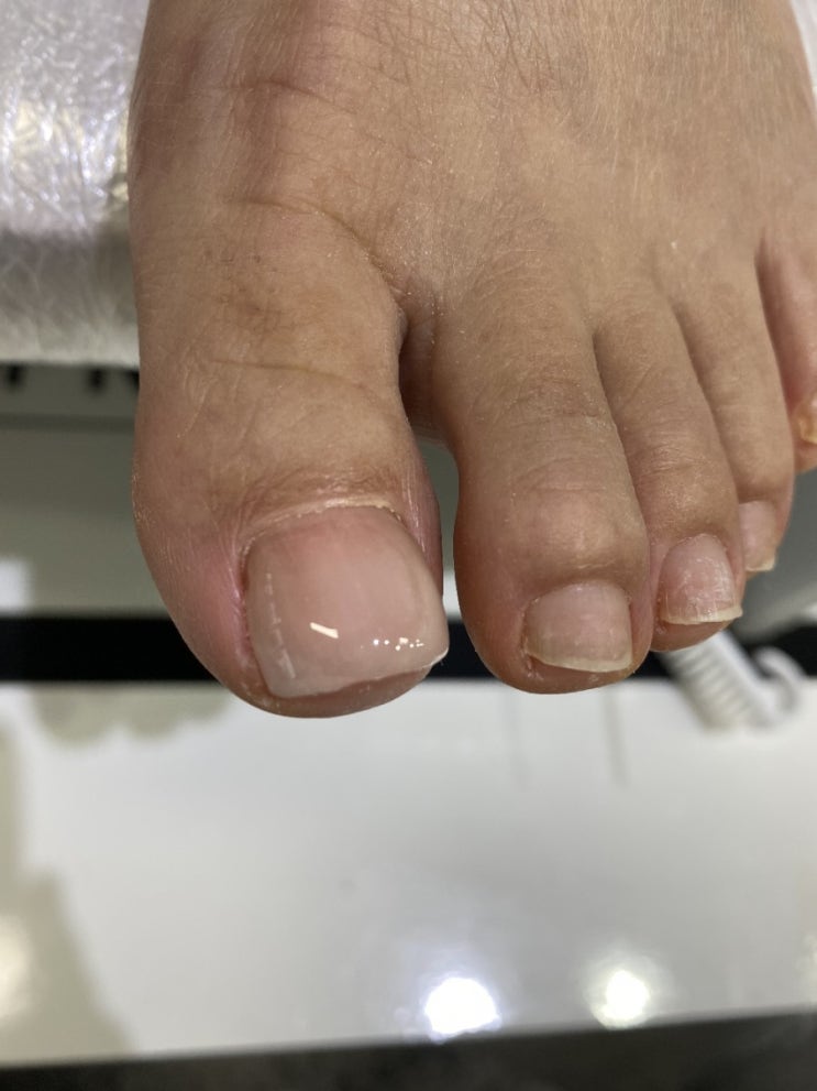  화성 오산 내성발톱, 무좀발톱, 발각질 전문 뷰네일샵에서
