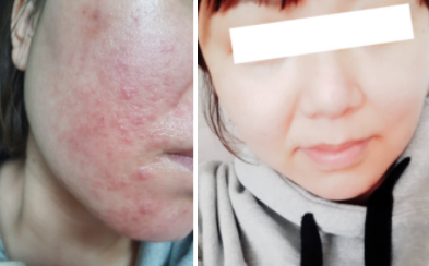  지루성피부염 연고 사용 전에 선택하면 좋은 방법