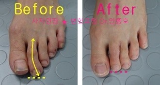  "발가락이 길어요" 장지증수술