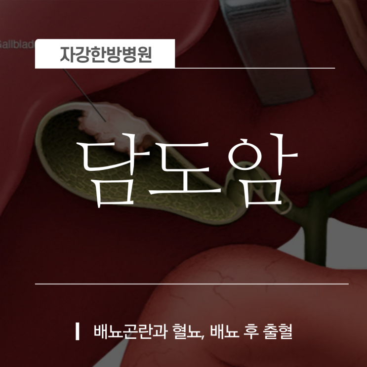  담도암 원인, 증상, 예방법, 그리고 '좋은음식'까지