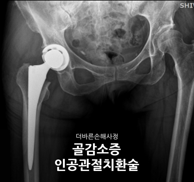 인공관절치환술(골감소증) 50대 여성 사례