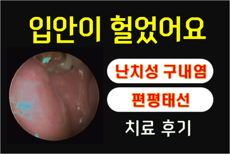  "입안이 헐었어요" 45세 여성 - 난치성 구내염, 편평태선 치료후기