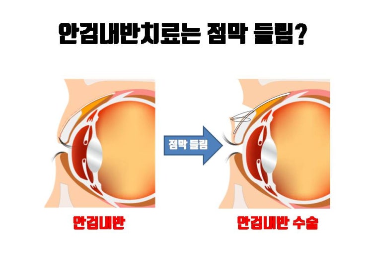  쌍수 부작용인 쌍수점막들림으로 안검내반증을 치료할 수 있어요!!!