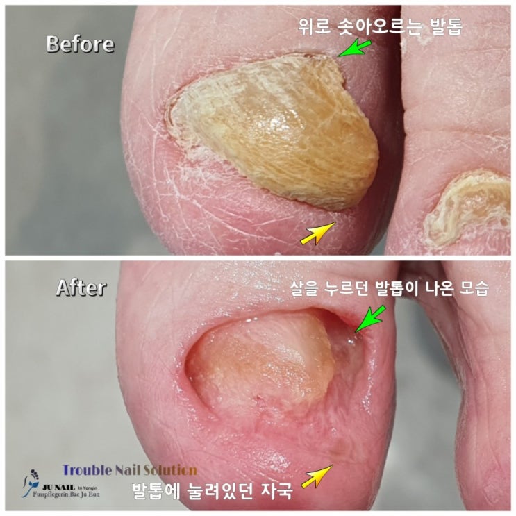 95세 할머니의 위로 자라서 두꺼운 무좀발톱이 아프고 깍기 힘들어요./성남수원수지보정동백죽전동/주네일/무좀파고드는내향성발톱손톱변형전문점