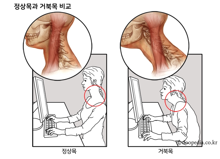  [건강] 경추성 편두통, 거북목을 의심하세요!