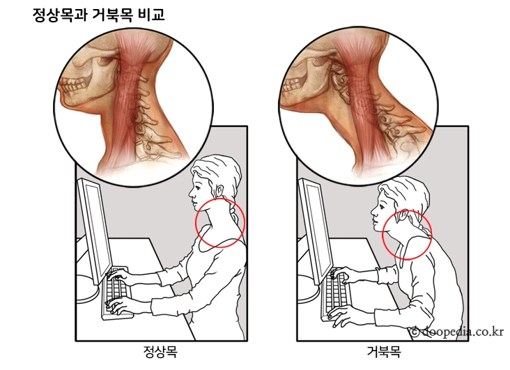 [건강] 경추성 편두통, 거북목을 의심하세요!