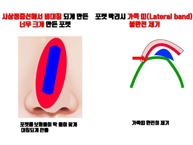  코수술 후 코보형물 움직임으로 코실리콘 휘어지는 이유 참 많죠!!!