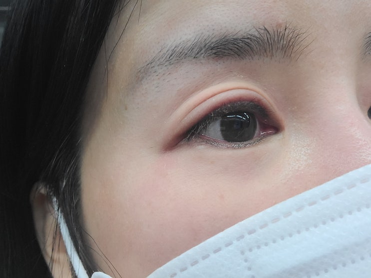 아이라인 반영구 제거 수술 2회차 리얼후기 내돈내산 / 붓기 / 병원정보 / 가격 아이라인 반영구 제거 수술 2회차 리얼후기 내돈내산 / 붓기 / 병원정보 / 가격