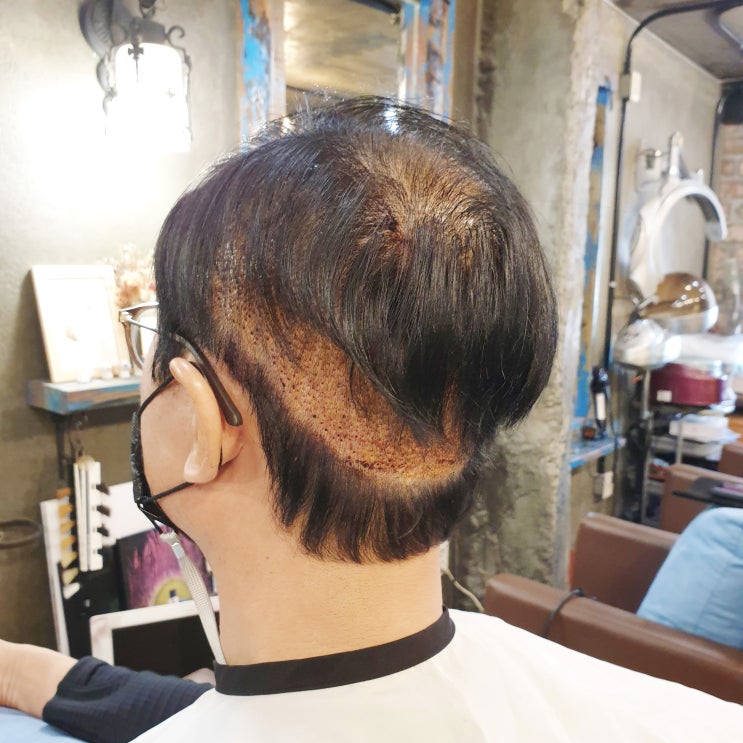  헤어라인모발이식 하기 전 모르면 큰일!
