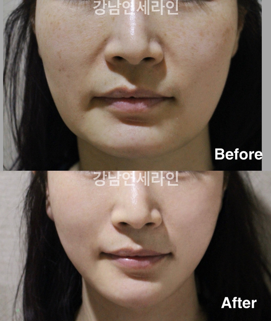  녹는실리프팅잘하는곳 시술접근방법