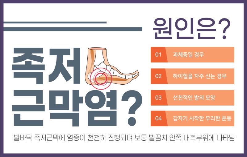 서초 오른발 발바닥 통증의 원인, 족저근막염의 원인은 무엇일까? 7
