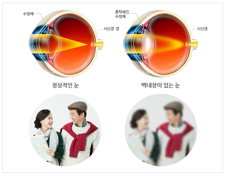 백내장 다초점 렌즈로 노안까지 케어해줍니다.