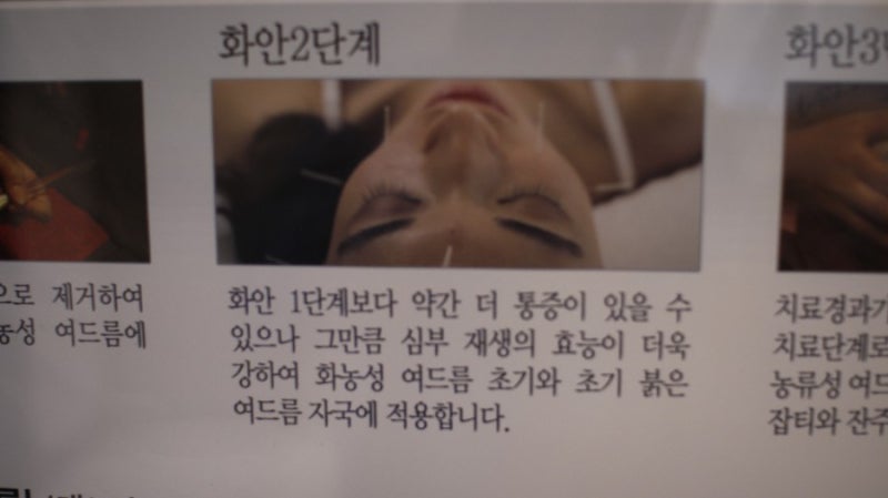 강남 모공강화증치료 닭살피부 화안케어 후기 4