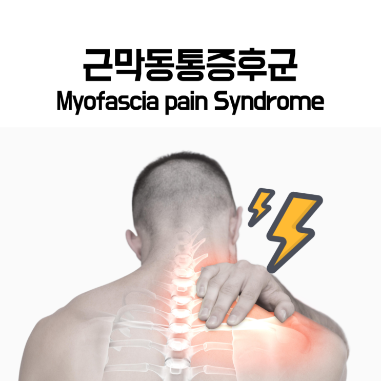  뒷목이 뻐근한 증상 그냥 둬도 될까요? 근막동통증후군의 모든 것