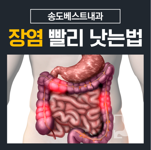 급성장염 빨리 낫는 법 장염 증상 예방법 6가지