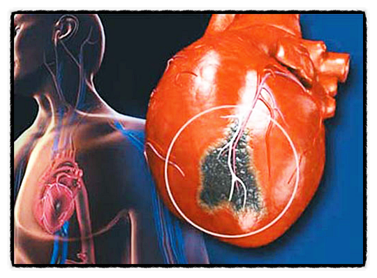 심장 산소 결핍 협심증 심근경색 관상동맥 통증