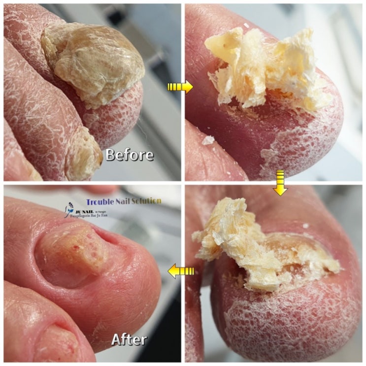 83세 할아버지의 두꺼운발톱 이렇게 해결했어요/성남수원수지보정동백죽전동/주네일/무좀파고드는내향성발톱손톱변형전문점