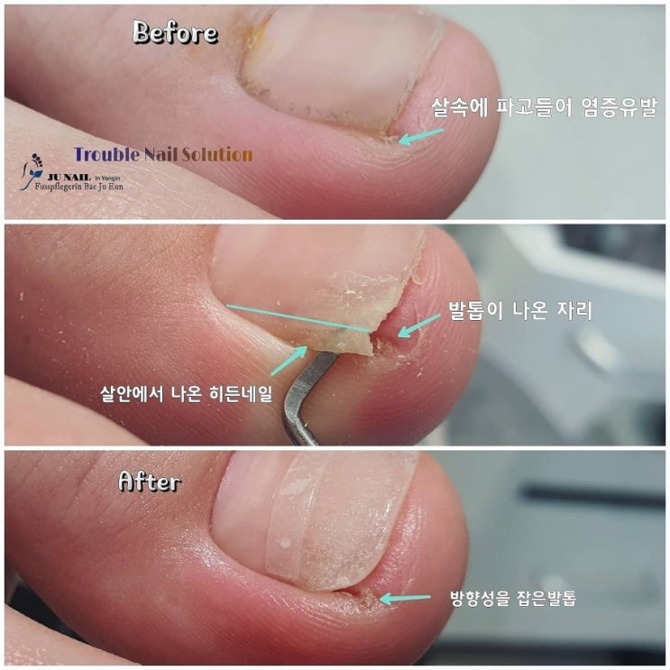 파고드는발톱 어떻게하나요? 참는다고 해결되지 않습니다./성남수원수지보정동백죽전동/주네일/무좀파고드는내향성발톱손톱변형전문점 파고드는발톱 어떻게하나요? 참는다고 해결되지 않습니다./성남수원수지보정동백죽전동/주네일/무좀파고드는내향성발톱손톱변형전문점